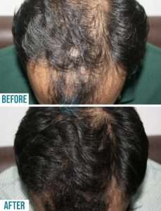 hair transplant