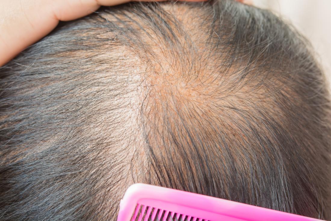 Popular Hair loss treatment in Pakistan