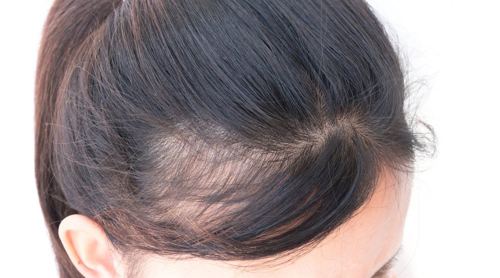 Popular Hair loss treatment in Lahore Pakistan
