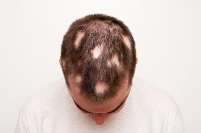 hiar-loss Hair Loss treatment in Lahore Pakistan