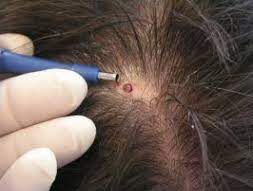 Scalp Biopsy