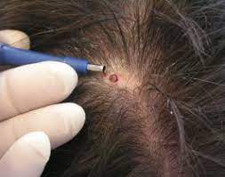 Scalp Biopsy