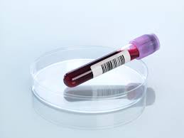 Blood Test help uncover medical conditions that can cause hair loss.