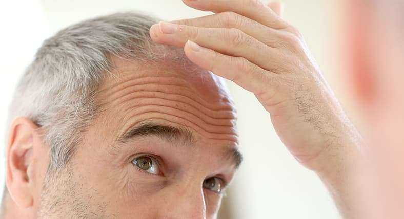 Aging Hair Loss treatment in Lahore Pakistan