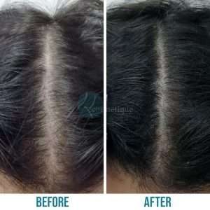 hair loss Hair Loss treatment in Lahore Pakistan