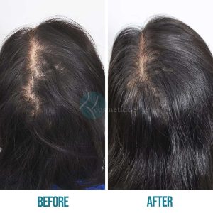 hair transplant Hair transplant in Lahore Pakistan