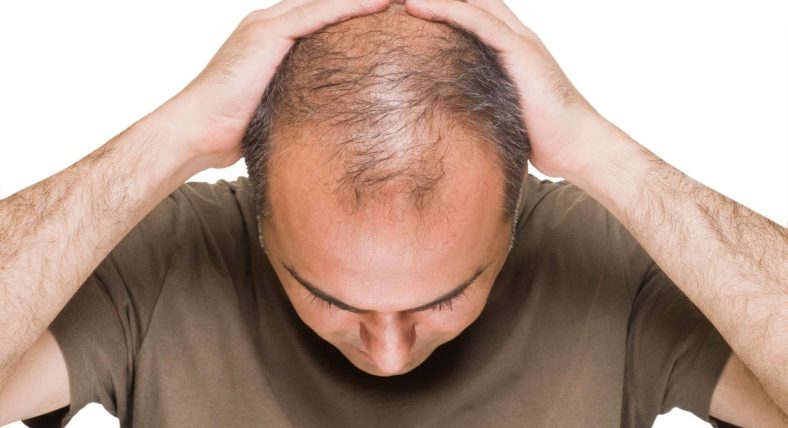 Stress For Hair Loss Hair Loss treatment in Lahore Pakistan