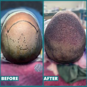 Hair Transplant Hair transplant in Lahore Pakistan