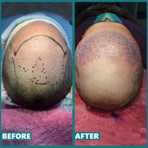 Hair Transplant Hair transplant in Lahore Pakistan